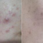 miraculeuse-soin-peaux-grasses-anti-acne